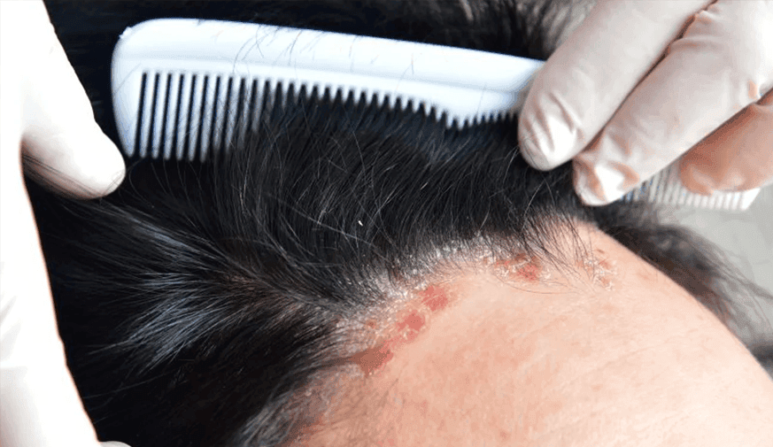 Is Deucravacitinib Better Than Placebo, Apremilast for Scalp Psoriasis?