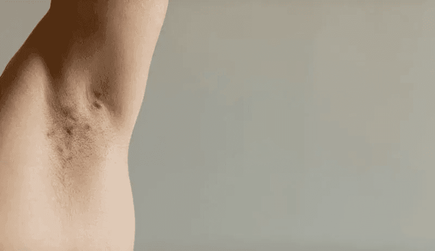 Variants at Two Loci Associated With Hidradenitis Suppurativa Risk