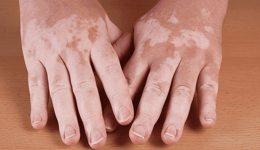 Is Dermoscopy, Reflectance Confocal Microscopy Combo Best for Assessing Vitiligo?