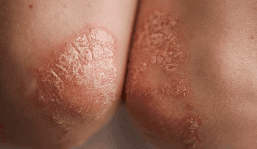 Extending Dosing Interval for Guselkumab Noninferior in Psoriasis