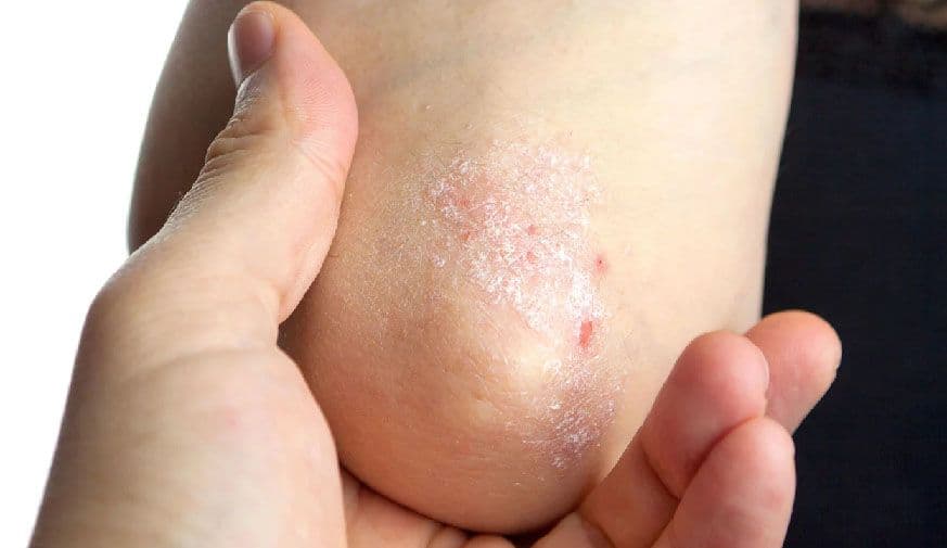 Moderate-to-Severe Psoriasis Tied to Lower Fertility Rates in Women