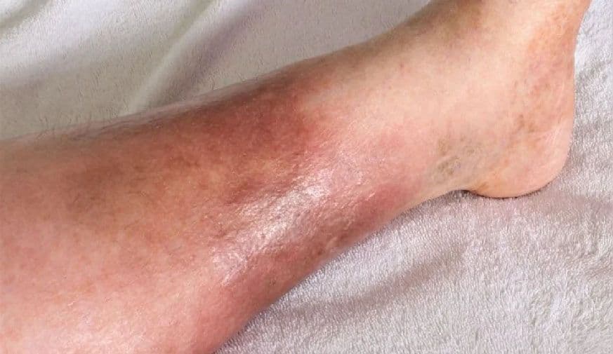 Chemotherapy-Induced Pseudocellulitis Described in Case Reports