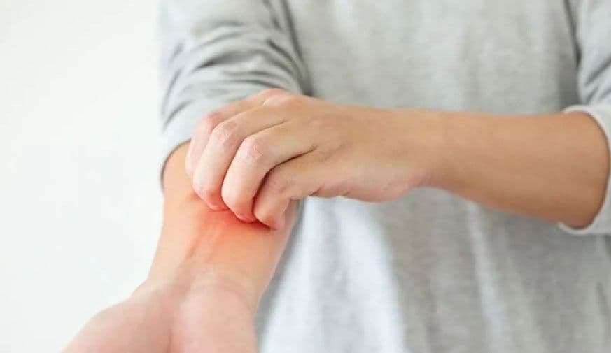 Prevalence of Atopic Diseases Increased in Sexually Diverse Individuals