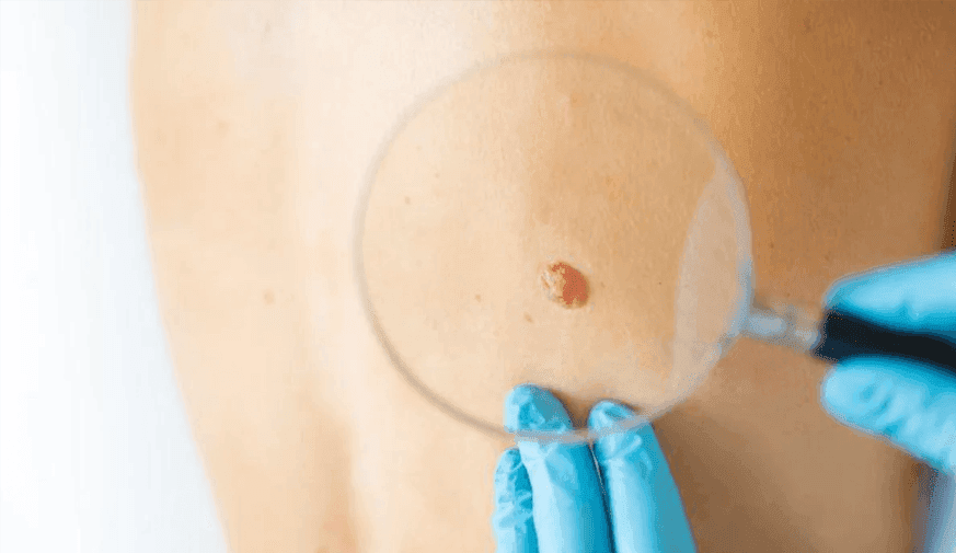 Melanoma Presentation, Mortality Varies by Race