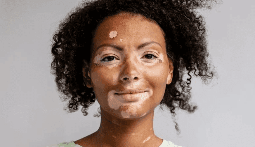 Incidence Rate of Diagnosed Vitiligo 22.6 per 100,000 Person-Years