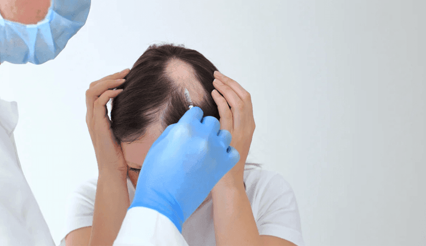 People With Alopecia Have Higher Risk for Inflammatory Arthritis