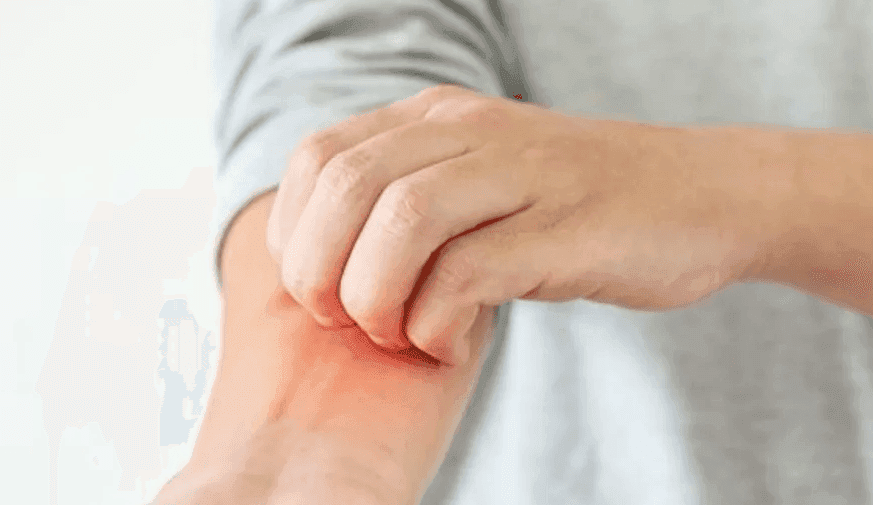 Higher Risk for Schizophrenia Seen Among Patients With Eczema