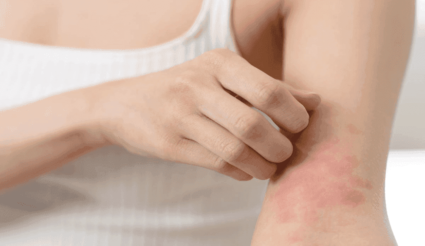 Dupilumab Maintains Its Effectiveness Up to Five Years in Patients With Eczema