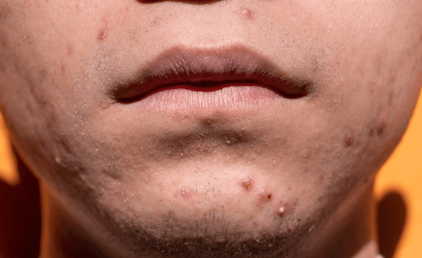LAUNCH ALERT: FDA Approves IDP-126 Gel for Acne Vulgaris
