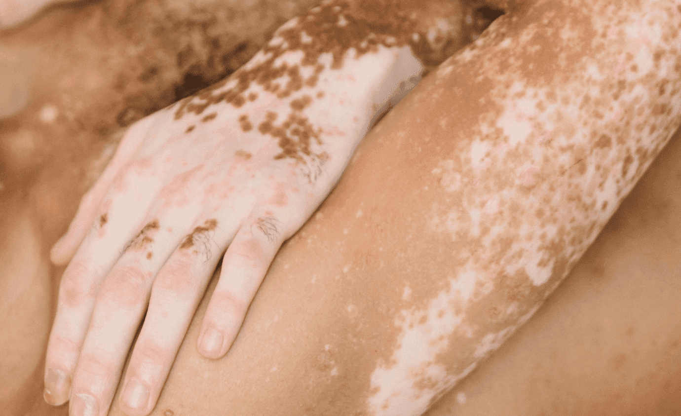 Research Roundup: Vitiligo