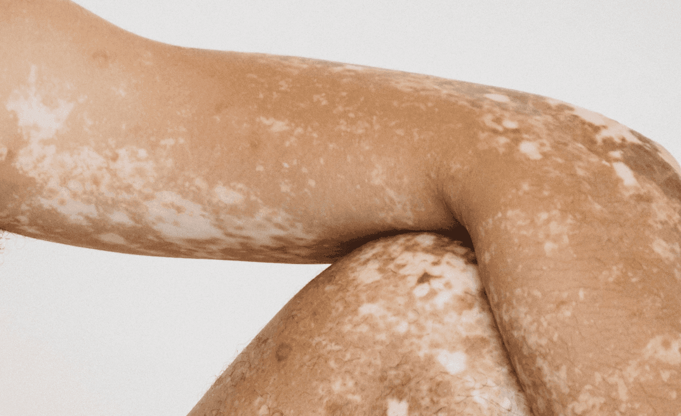 Vitiligo and Associated Comorbidities: A Review  