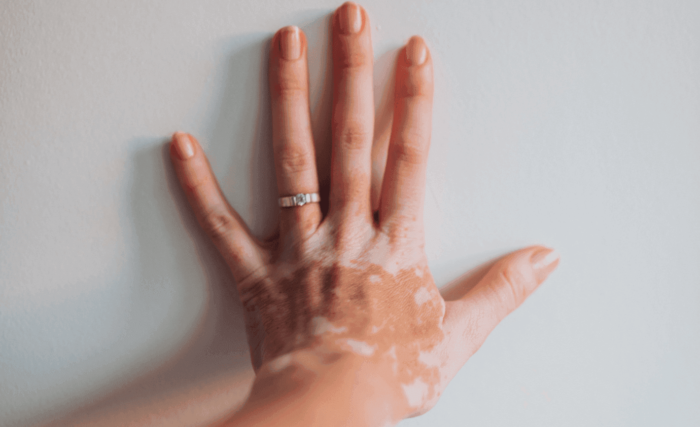 Illuminating the Path to Skin Repigmentation