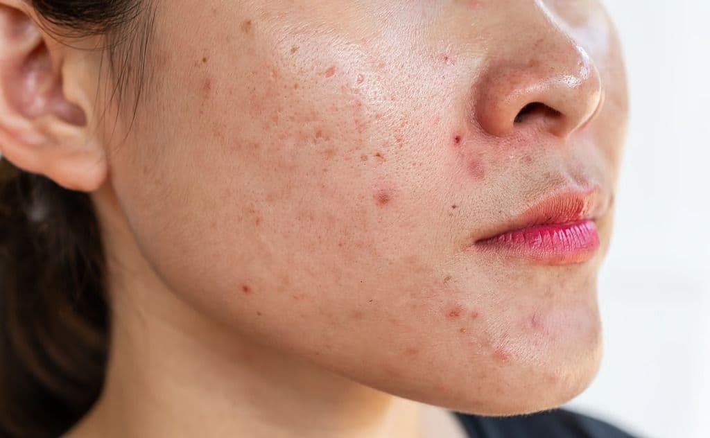 Distinct Acne Incidence Patterns Seen in Transgender Individuals