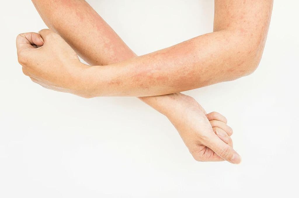 AI Three-Item Severity Score Can ID Eczema From Patient-Uploaded Images
