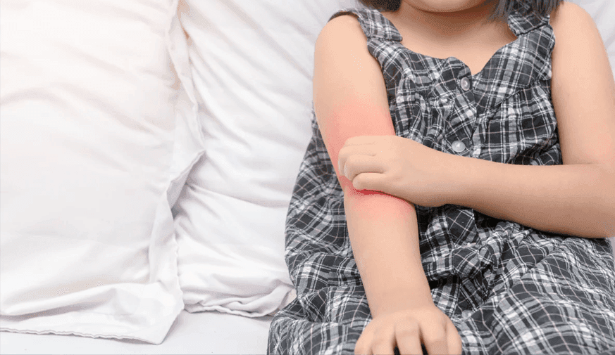 Atopic Dermatitis Increases Risk for Inflammatory Bowel Disease