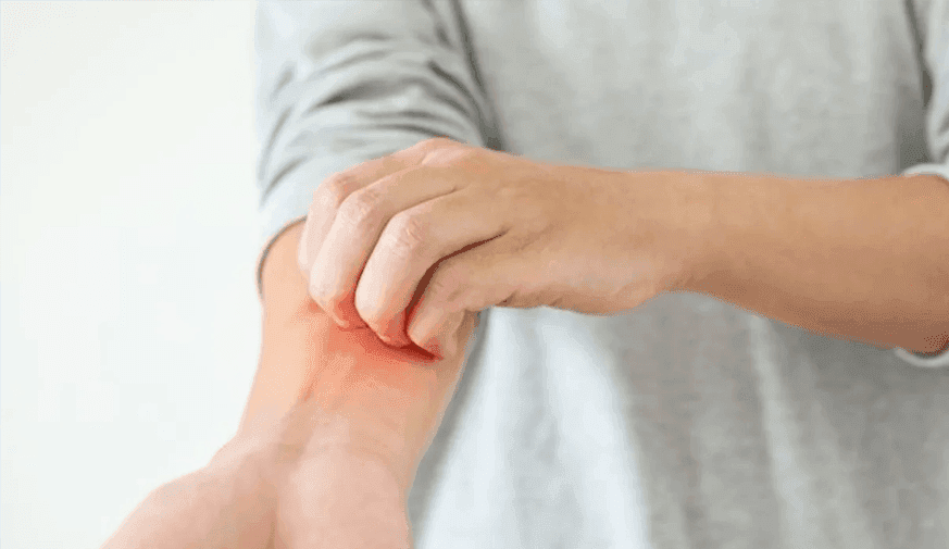 Dupilumab Treatment Beneficial for Sleep in Atopic Dermatitis