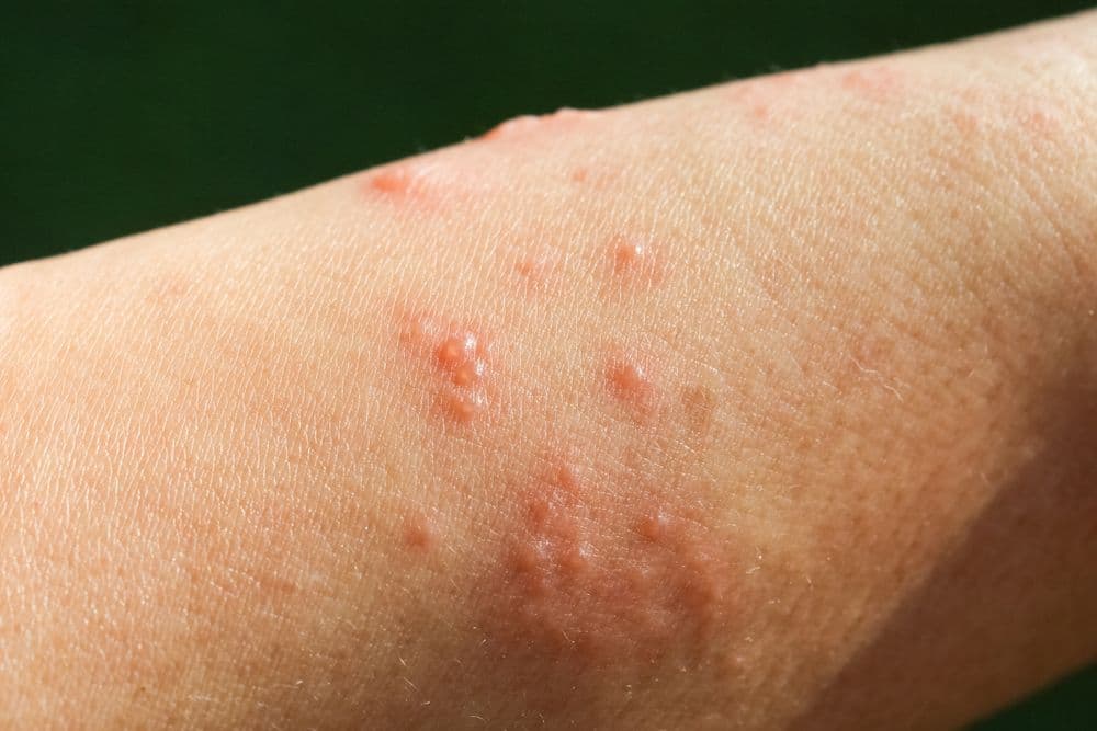 Launch Alert: FDA Approves Dupixent (Dupilumab) for Adults with Bullous Pemphigoid