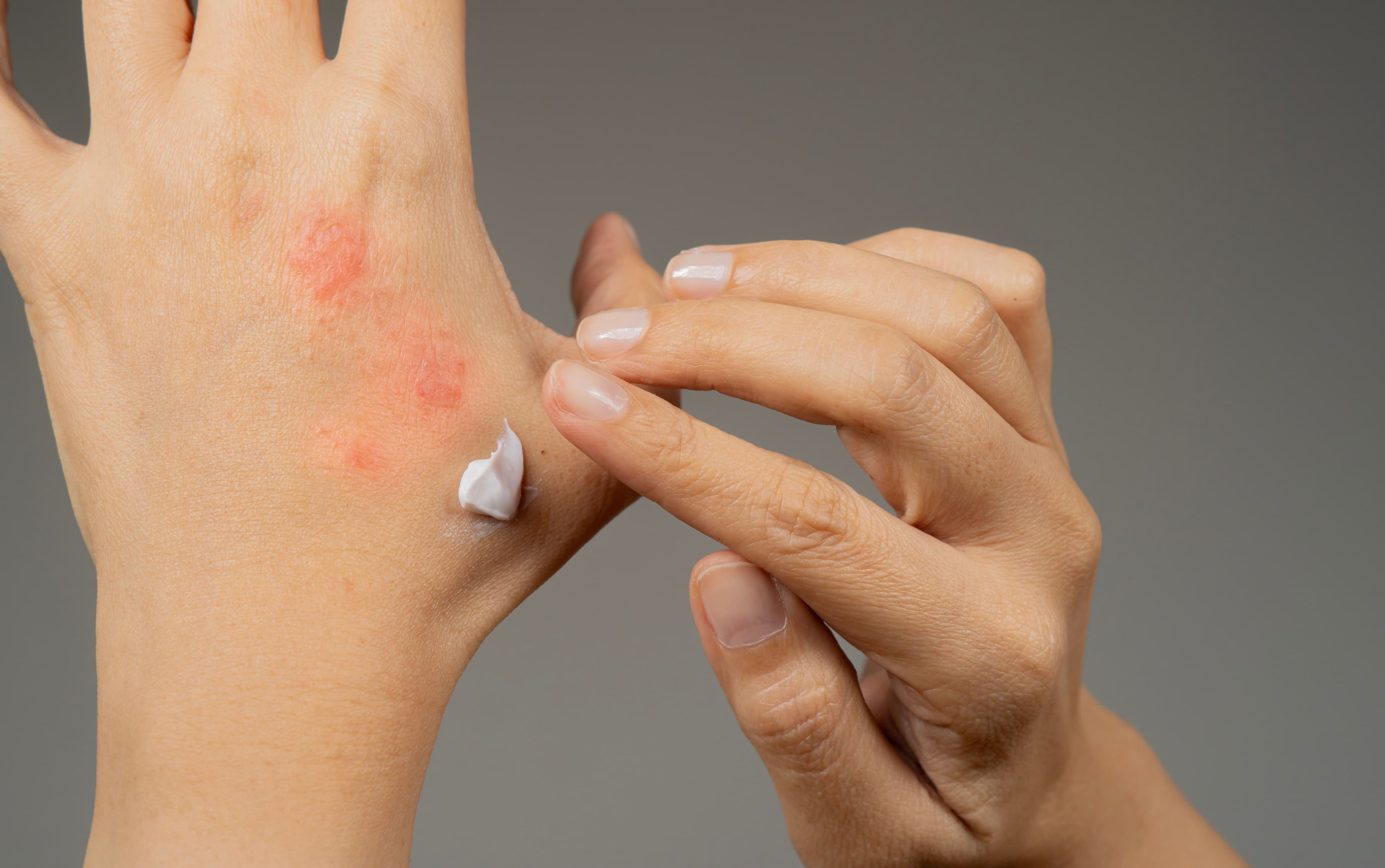 LAUNCH ALERT: FDA Approves Anzupgo (Delgocitinib) Cream for Moderate-to-Severe Chronic Hand Eczema in Adults 