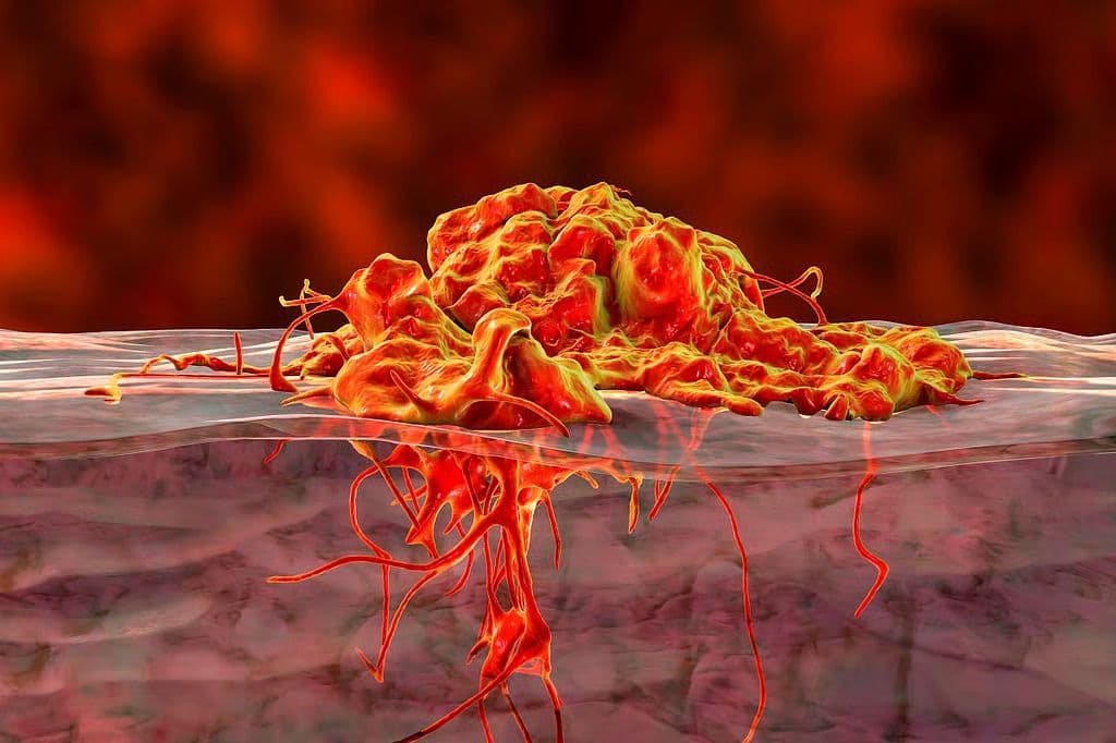 Risk for Death Reduced With Sentinel Node Biopsy in Melanoma
