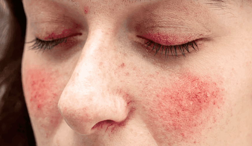 FDA Approves Emrosi for Rosacea in Adults
