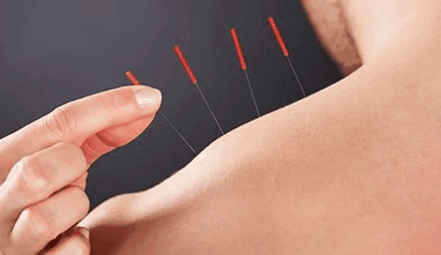 Acupuncture Offers Some Benefit in Chronic Spontaneous Urticaria