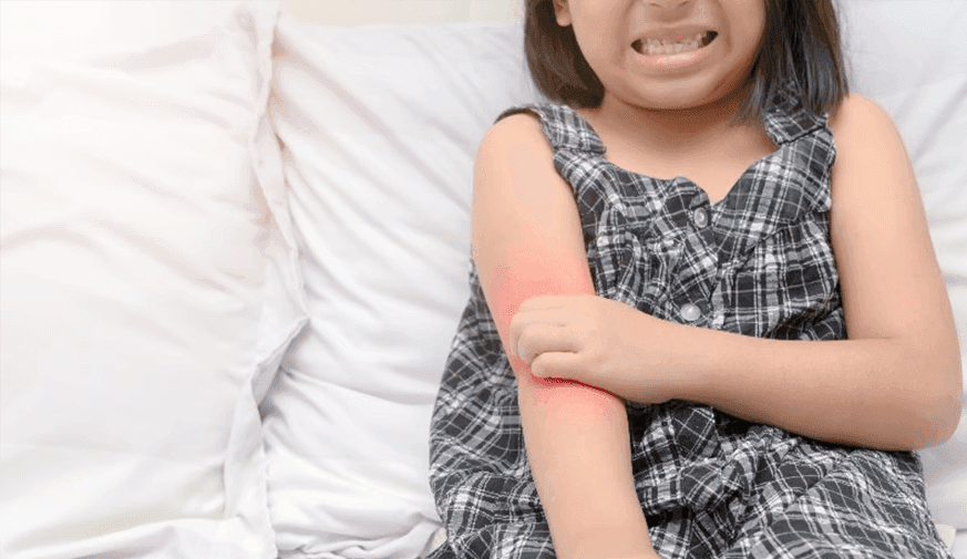 Atopic Dermatitis in Children Tied to Learning, Memory Difficulties