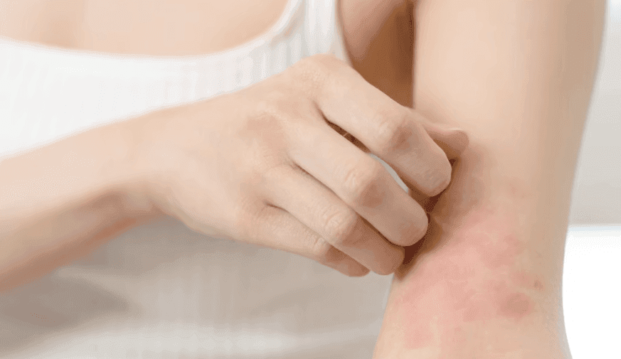 Risk for Meniere Disease Higher in Patients With Atopic Dermatitis