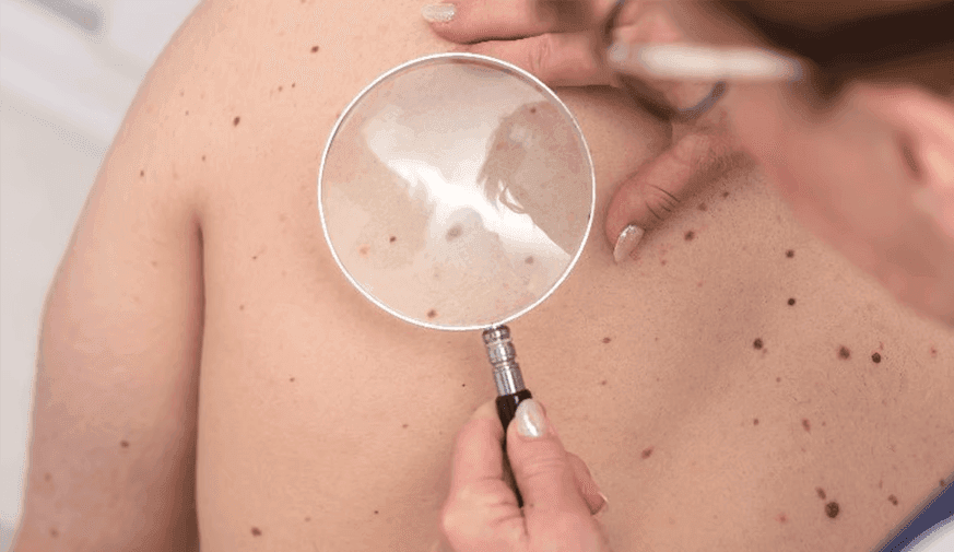 Delayed Melanoma Care During Pandemic Proved Costly