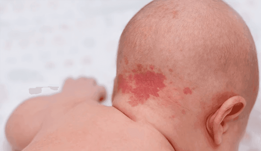 Once-Weekly Pulsed Dye Laser Beneficial for Port-Wine Birthmarks
