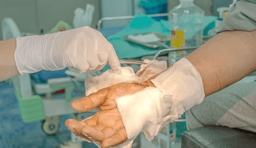 Study Looks at Access to U.S. Burn Centers Using 2019 Data