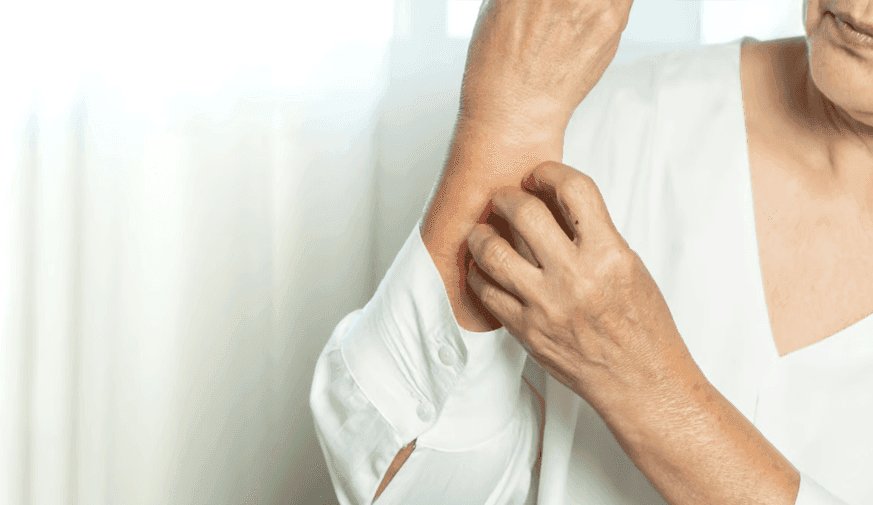 Antihypertensives Linked to Eczematous Dermatitis in Seniors