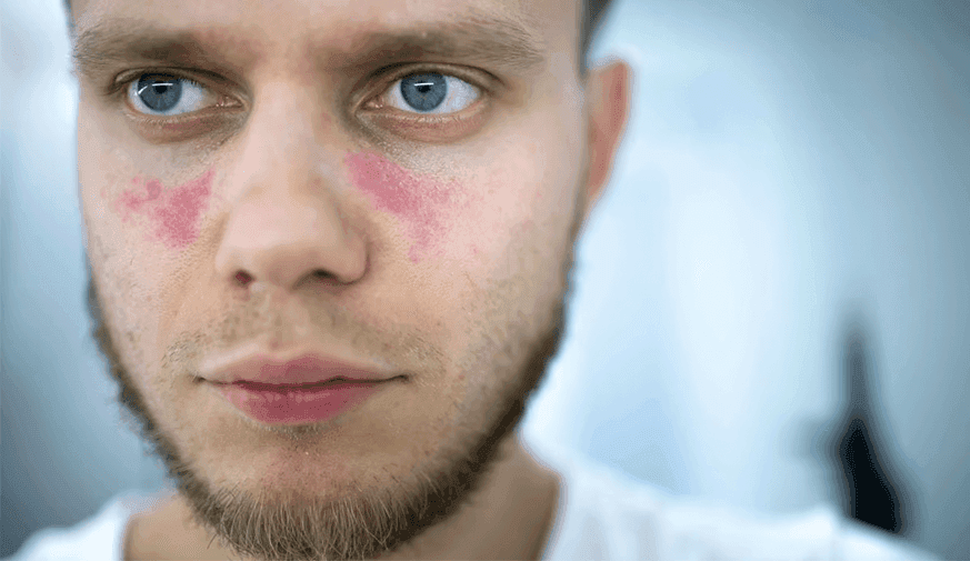 Residence in Disadvantaged Area Tied to Discoid Lupus Erythematosus Severity