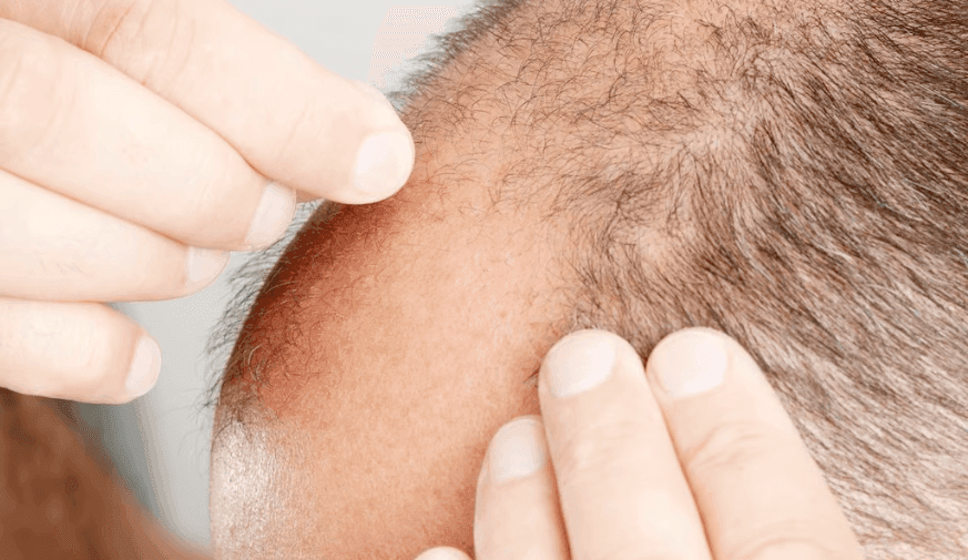 Robotic Hair Transplant Technology ARTAS Found to Be Safe, Effective