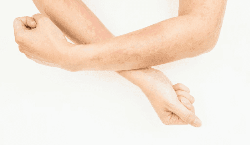 Burden of Superficial Cutaneous Fungal Infection Quantified in U.S.