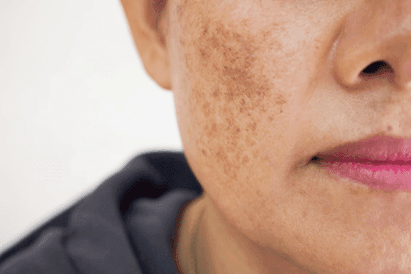 Platelet-Rich Plasma, Tranexamic Acid + Microneedling Beneficial for Melasma