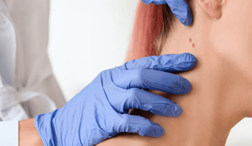 Risk for cSCC Metastases Increased for Solid Organ Transplant Recipients