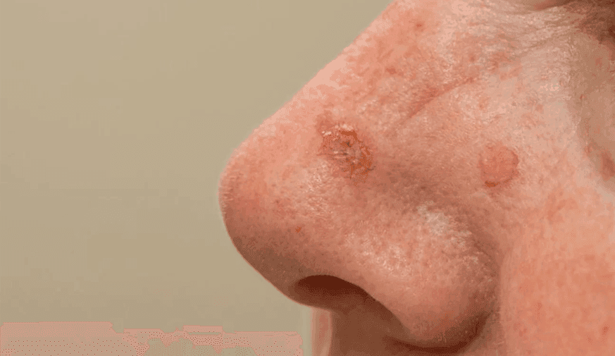 Is There an Increased Risk for Skin Cancer for Older Adults With Actinic Keratoses?