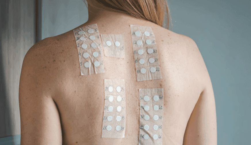 Patch Test Positivity Rate Varies From 13 to 100 Percent for Cosmetics