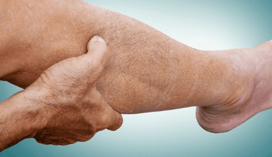 Risk for Skin Cancer Increased for Patients With Lower Extremity Lymphedema