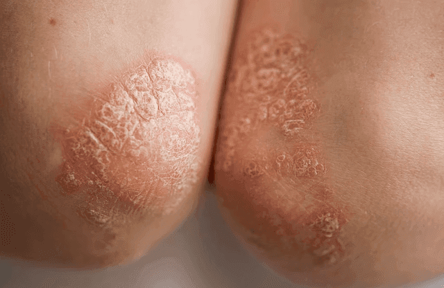 Real-World Study Shows Effectiveness of Ixekizumab for Psoriasis