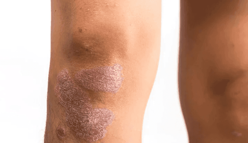 Biological Agent Trials for Psoriasis Rarely Include Patient Images