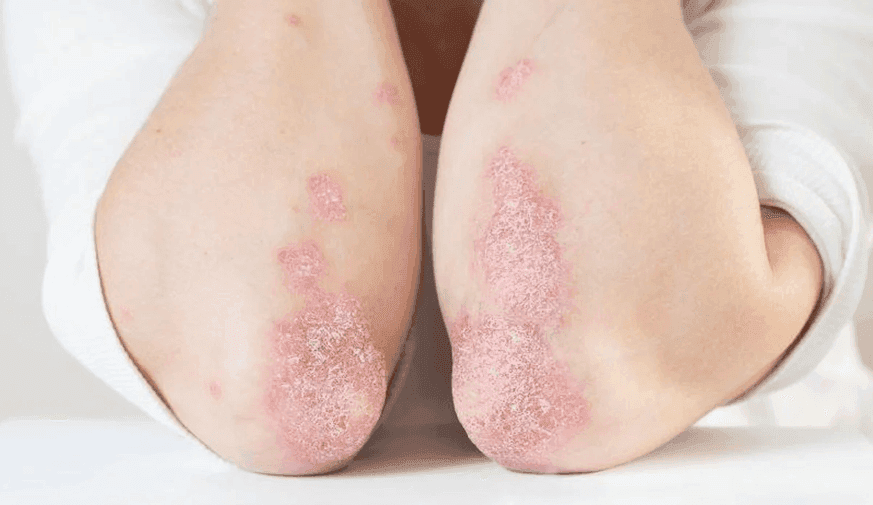 Incidence of Dermatologic Disease Persists in People With HIV