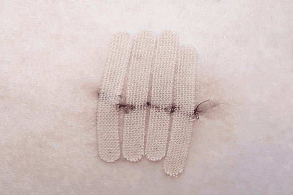 Residual Tumor Common in Patients Undergoing Mohs for Basal, Squamous Cell Cancers