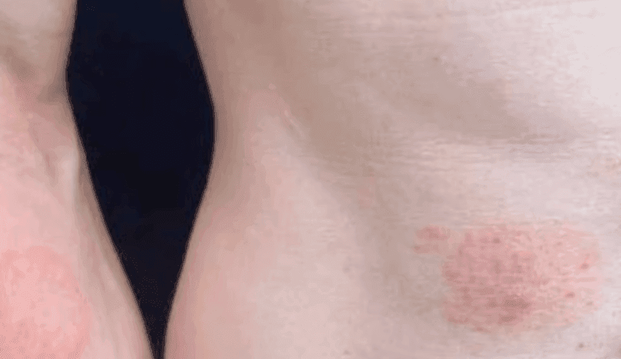 First Cases of Sexually Transmitted Ringworm Reported in the U.S.