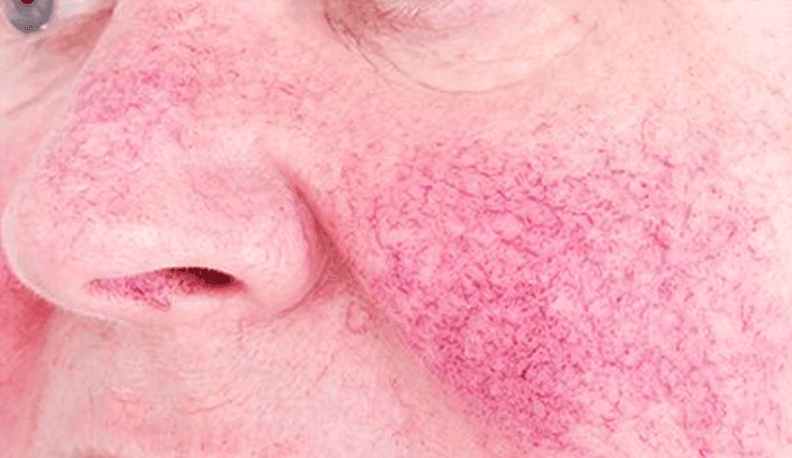 Erenumab Effective, Safe for Rosacea-Linked Erythema, Flushing