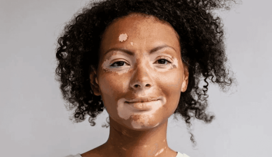 Recommendations Developed for Managing Vitiligo in Young Patients