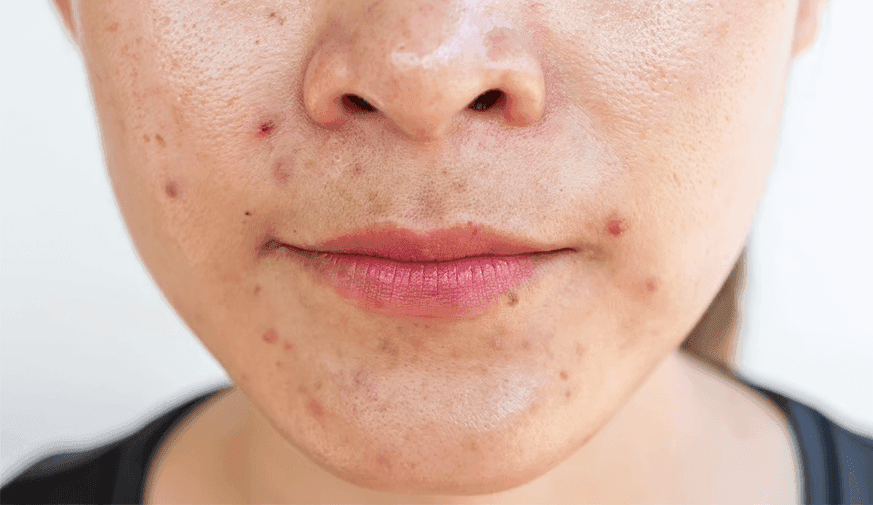 Direct CGRP Inhibition Cuts Acne, Rosacea in Patients With Migraine