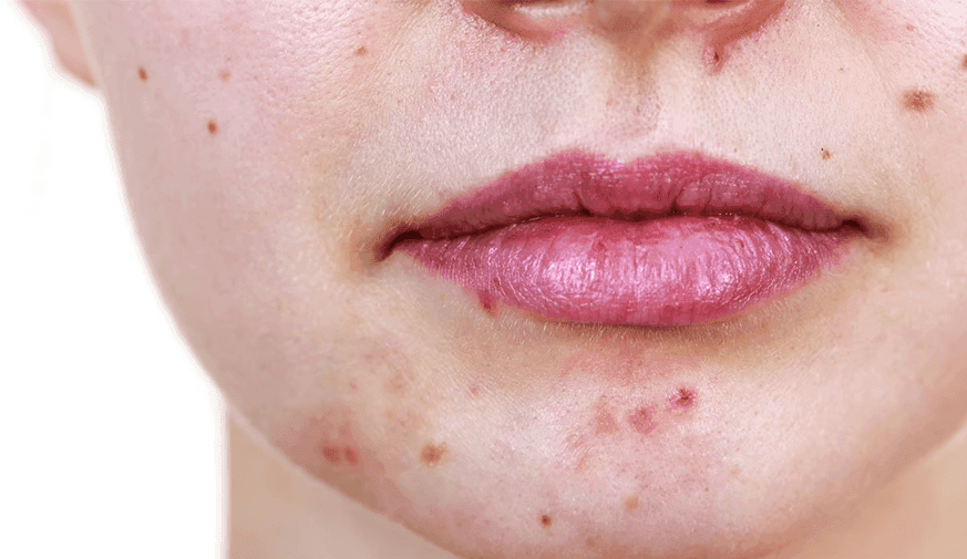 At-Home Light-Emitting Diode Devices Safe, Effective for Acne Treatment