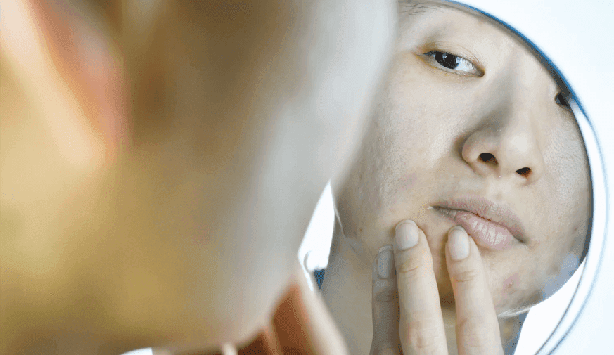 2004 to 2019 Saw Increase in Isotretinoin Use in Girls, Women