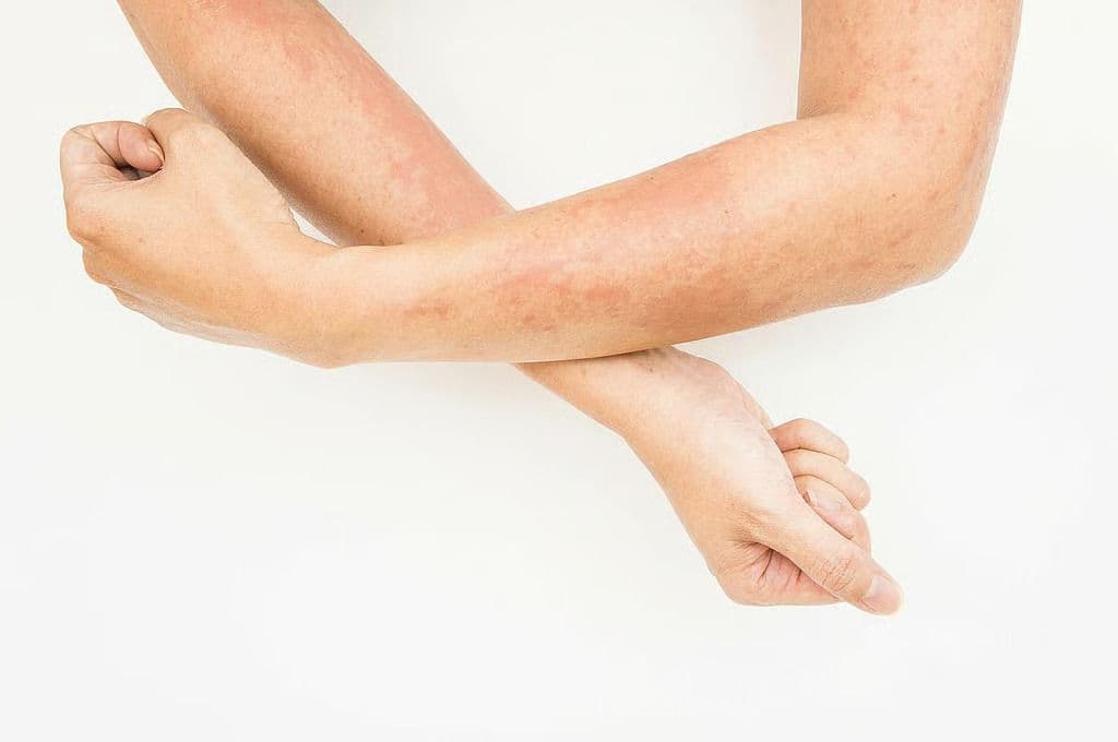 Psoriasis Risk Higher for Patients With Eczema Treated With Dupilumab